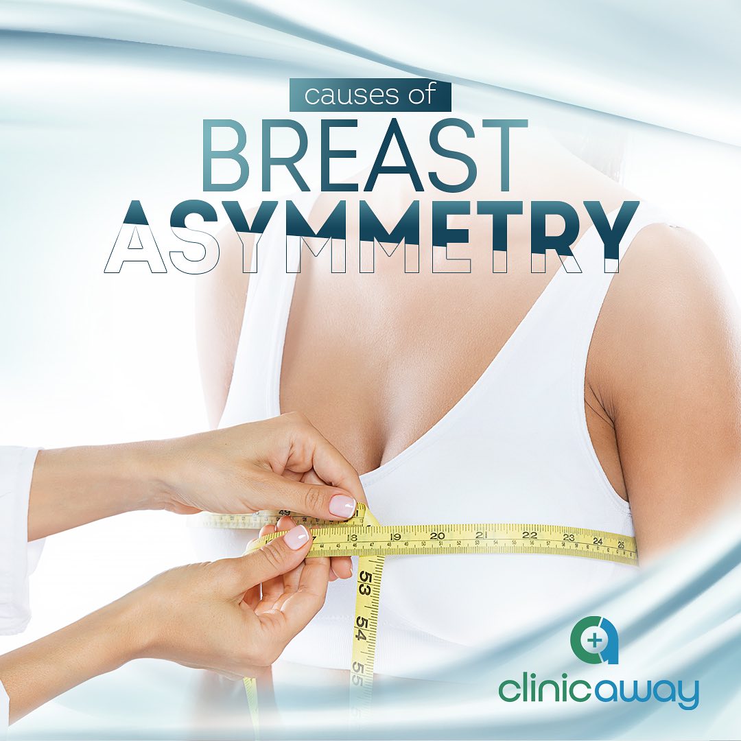 Causes of Breast Asymmetry
