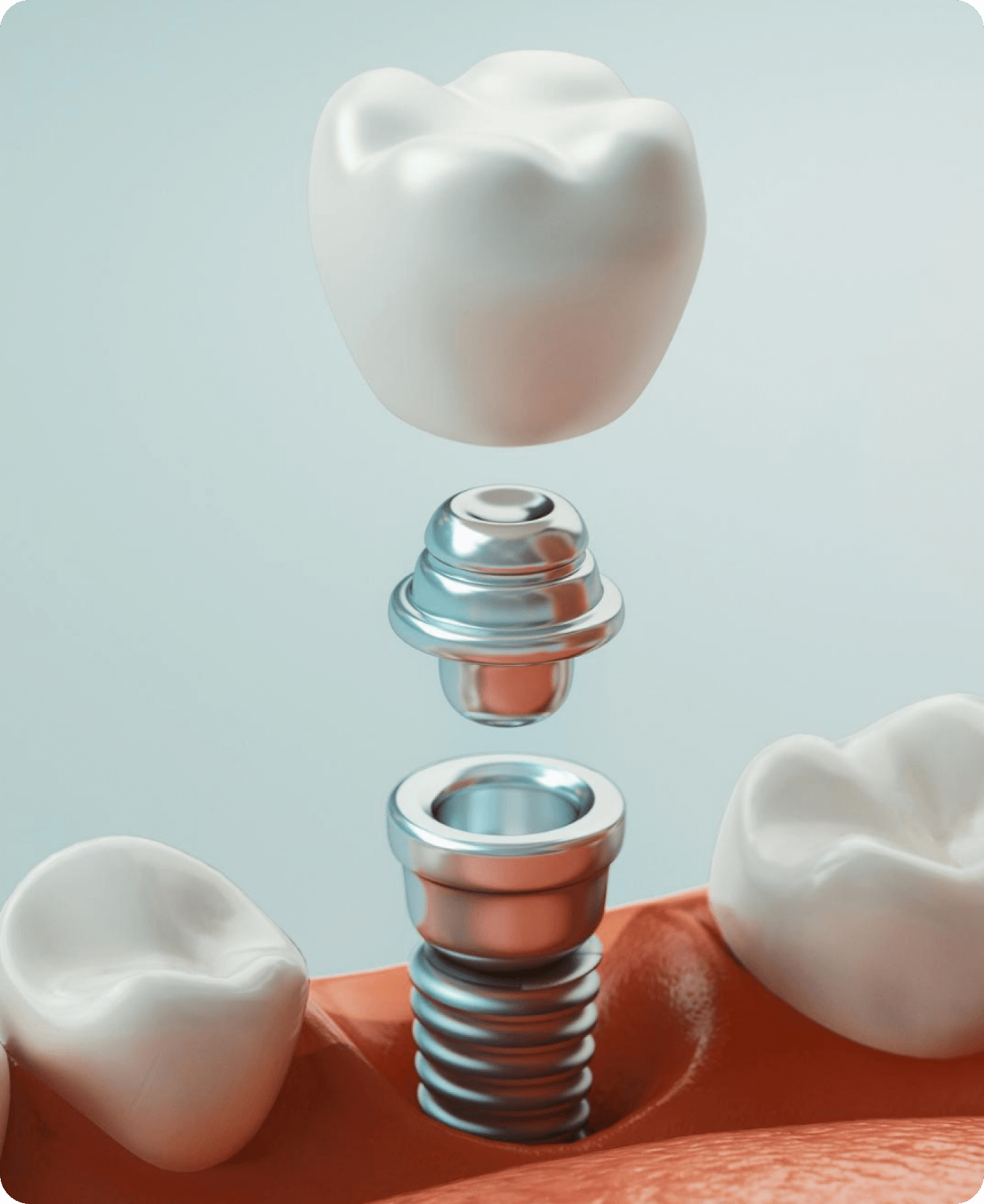 Dental Implants