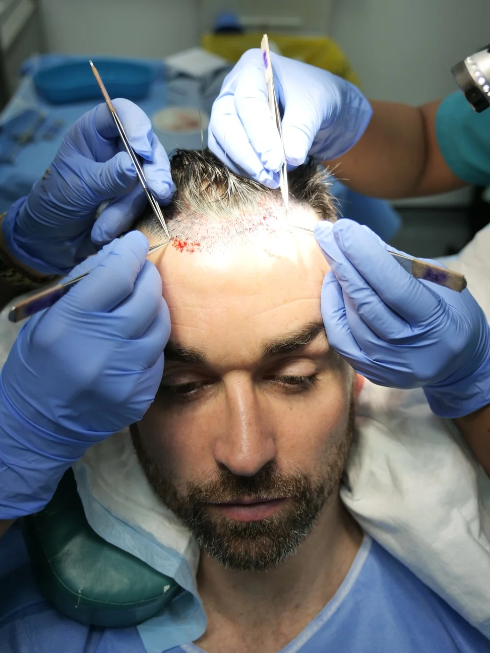 DHI Hair Transplant